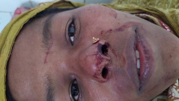 বরগুনায় সরকারি ৪৫০ টাকার জন্য আহত